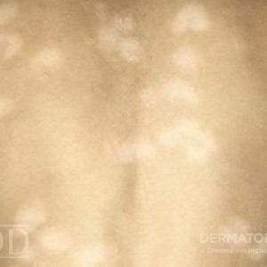 DermAtlas_JDD_M7531_Psoriasis_Hypopigmentation