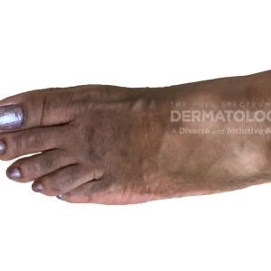 DermAtlas_Ctcl_GW_lower-extremity-anterior-oblique-left-09.18.2023-56567595