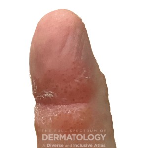 DermAtlas_contactderm_GW_2