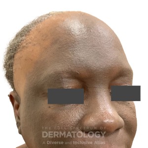 DermAtlas_Lichen planus pigmentosus and frontal fibrosing alopecia_GW_6b