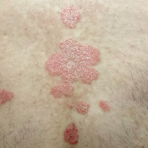 DermAtlas_Psoriasis vulgaris_full-body-posterior