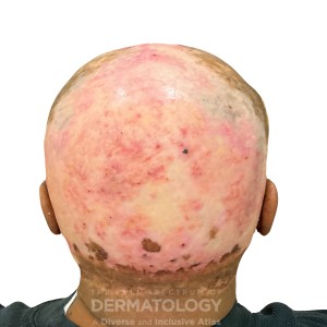 DermAtlas_Discoid lupus erythematosus_GW3 R1