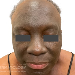 DermAtlas_fullface_Lichen planus pigmentosus and frontal fibrosing alopecia_GW_1