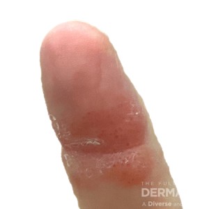 DermAtlas_contact derm_GW_1