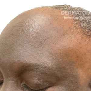 DermAtlas_Lichen planus pigmentosus and frontal fibrosing alopecia_GW_2b