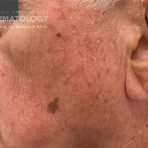 DermAtlas_Seborrheic keratosis_Actinic keratosis_GW_1