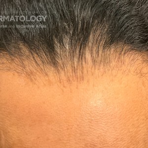 DermAtlas_Frontal fibrosing alopecia_2