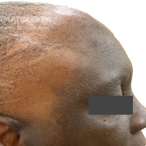 DermAtlas_Lichen planus pigmentosus and frontal fibrosing alopecia_GW-5