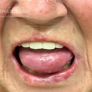 DermAtlas_Oral lichen_planus_tongue_GW_4