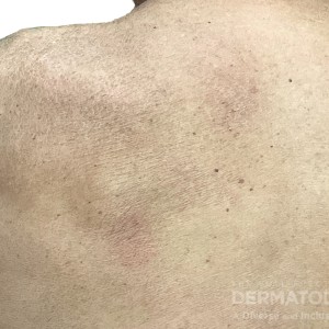 DermAtlas_Cutaneous T cell lymphoma _full-body-posterior-08.23.2023-55280156