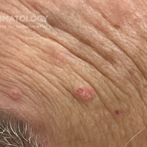 DermAtlas_Sebaceous hyperplasia_dermatofibromas_closeup_5