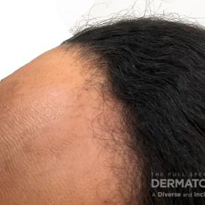 DermAtlas_Frontal fibrosing alopecia and lichen planus pigmentosus_profile3