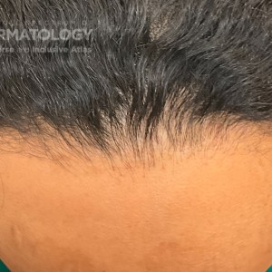 DermAtlas_Frontal fibrosing alopecia and lichen planus pigmentosus_1