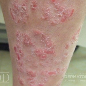 DermAtlas_JDD_M7531_Ped_Psoriasis_Leg1