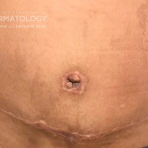 DermAtlas_PIH 2_2 ACD_abdomen-anterior-10.02.2023-57282219