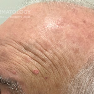 DermAtlas_Sebaceous hyperplasia_dermatofibromas_5