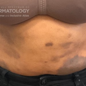 DermAtlas_Ctcl_GW_abdomen-anterior-09.18.2023-516567462