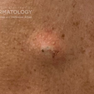 DermAtlas_Epidermal cyst_GW_7