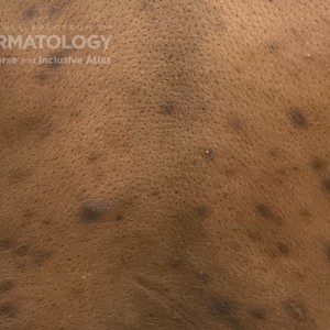 DermAtlas_Folliculitis_back_GW_3closeup