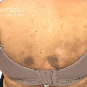 DermAtlas_Ctcl_GW_abdomen-posterior-09.18.2023-56567358