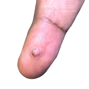 DermAtlas_Pyogenic granuloma