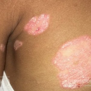 DermAtlas_JDD_0823_Ped_Psoriasis_trunk1