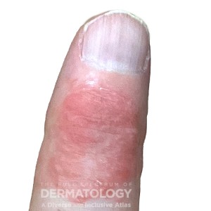 DermAtlas_Contactderm_GW_4