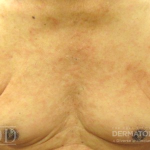 DermAtlas_JDD_C7196_BullousPemphigoid_2