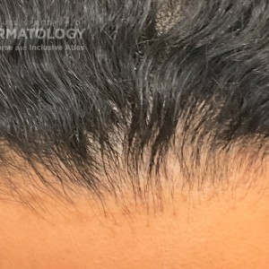 DermAtlas_Frontal fibrosing alopecia_closeup1