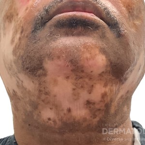 DermAtlas_Discoid lupus erythematosus_GW7