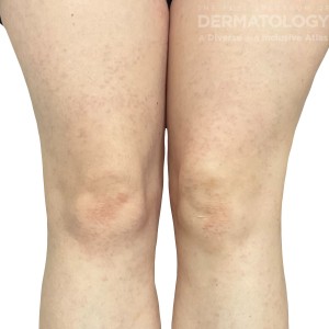 DermAtlas_Granuloma annulare (minimal activity)_lower-extremity-anterior-09.15.2023-56487679 R1