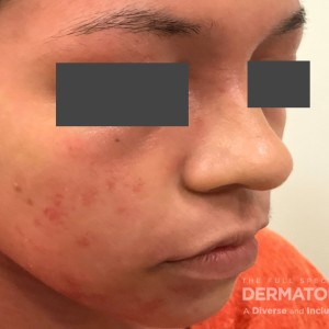 DermAtlas_Atopic dermatitis_face-oblique-right-10.30.2023-58759263