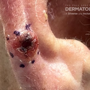 DermAtlas__Merkel cell2