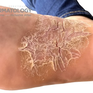 DermAtlas_dyshidrotic_eczema_foot1