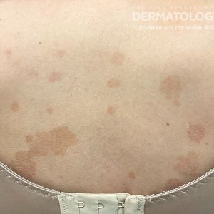 DermAtlas_Tinea versicolor -11.06.2023-59115264