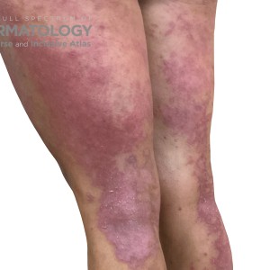 DermAtlas_Atopic dermatitis_lower-extremity-posterior-oblique-left-10.30.2023-587597032