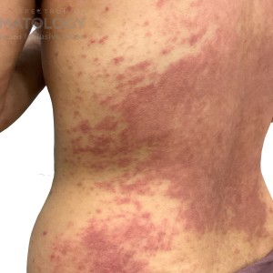 DermAtlas_Atopic dermatitis _abdomen-posterior-oblique-left-10.30.2023-58759960