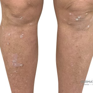 DermAtlas_Psoriasis_lower-extremity-anterior-10.16.2023-58011644