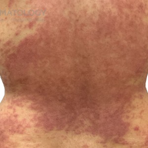 DermAtlas_Atopic dermatitis _abdomen-posterior-10.30.2023-58759986