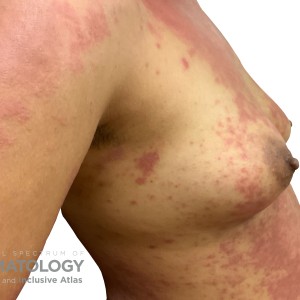 DermAtlas_Atopic dermatitis_upper-body-lateral-right-10.30.2023-58759410