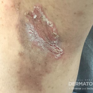 DermAtlas_Hailey Hailey Disease_GW3