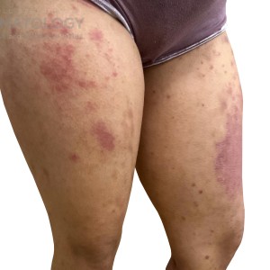 DermAtlas_Atopic dermatitis_lower-extremity-anterior-turn-out-left-10.30.2023-58759616