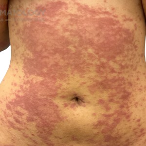 DermAtlas_Atopic dermatitis_abdomen-anterior-10.30.2023-58759911