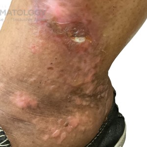 Bullous pemphigoid -11.10.2023-59475011 closeup