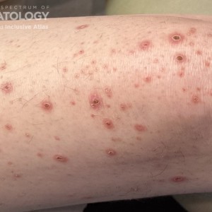 DermAtlas__leukocytoclastic vasculitis closeup