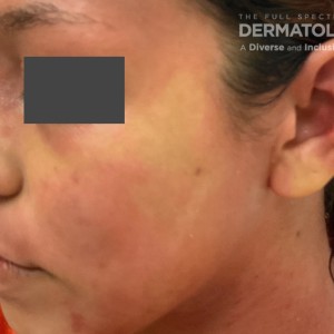 DermAtlas_Atopic dermatitis_face-oblique-left-10.30.2023-58759232