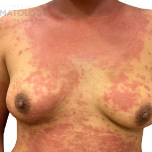 DermAtlas_Atopic dermatitis upper-body-anterior-10.30.2023-58759311