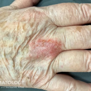 DermAtlas_Nummular eczema_11.06.2023-591638161