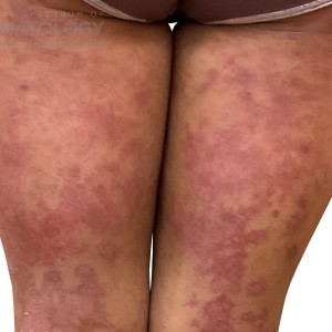 DermAtlas_Atopic dermatitis_lower-extremity-posterior-10.30.2023-587597262