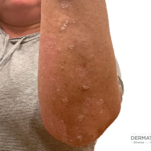 DermAtlas_Psoriasis_arms-posterior-level-left-10.16.2023-58012418